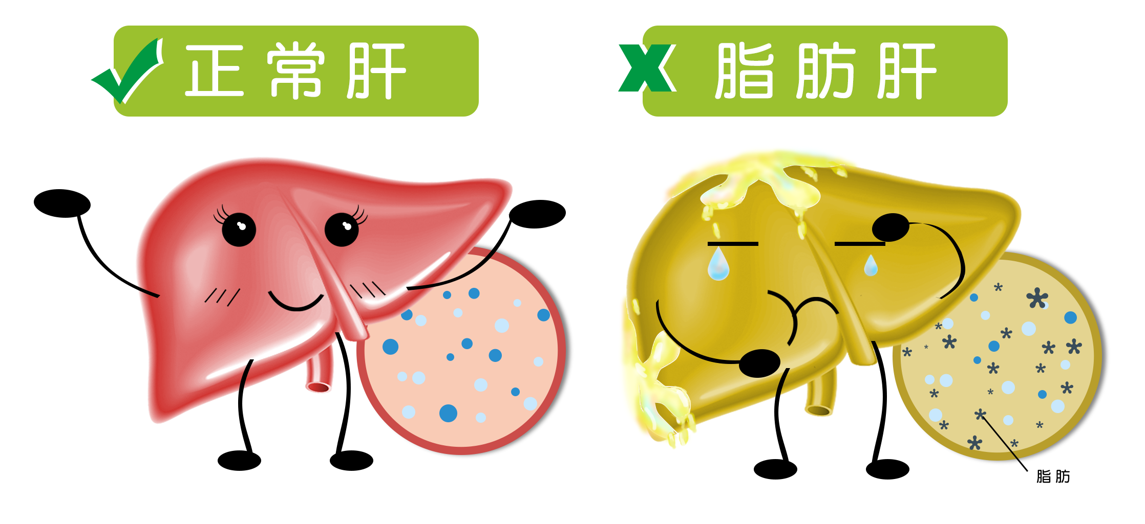 水蛭素可预防、改善脂肪肝问题