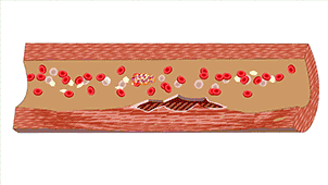 金康道夫科普|高血压引起动脉粥样硬化