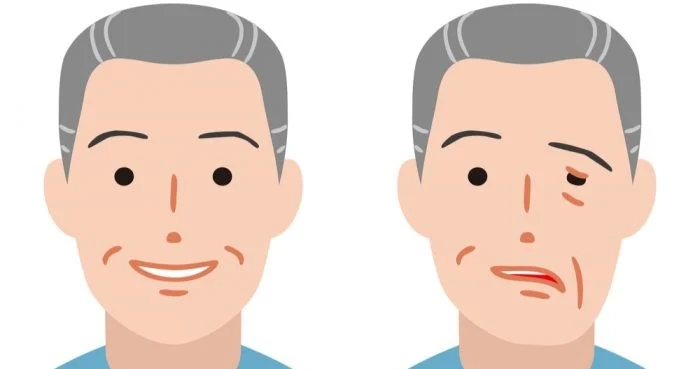 脑梗都有哪些前期症状？如何预防？