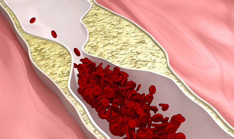 高血压引起动脉粥样斑块？水蛭素如何有效改善？
