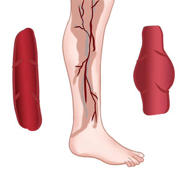 下肢静脉曲张是什么原因引起的？