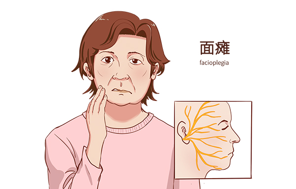 【科普】面瘫是什么原因引起的？