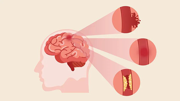 天然水蛭素可调节急性脑梗死